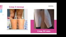 Резултат с намаляване на диоптера - Videoclip.bg