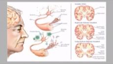 Академия "Здравословно": Най-тежката деменция - Алцхаймер - Videoclip.bg