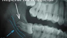 Откриване и изваждане на ретиниран мъдрец! Extraction of horizontal Lt. Mn third molar - Videoclip.bg